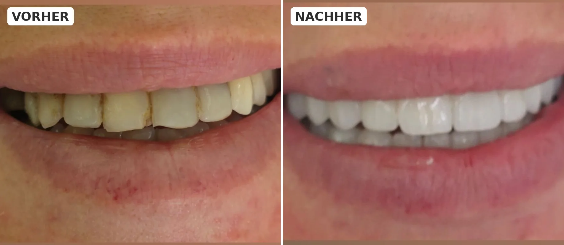 Vorher und nachher einer ästhetischen Lächelkorrektur - Elite Dent