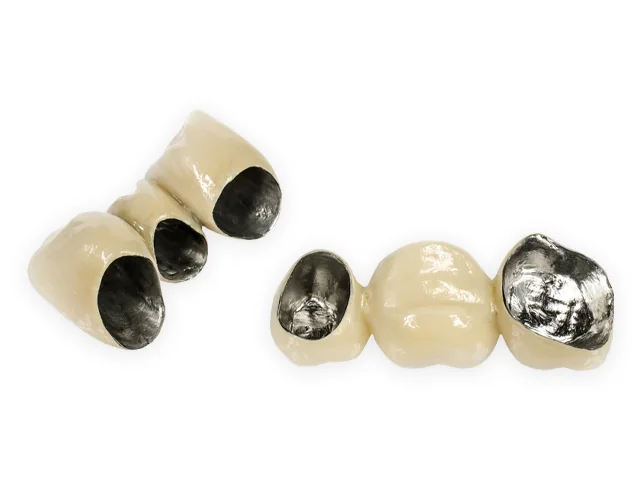 Metallkeramische Kronen