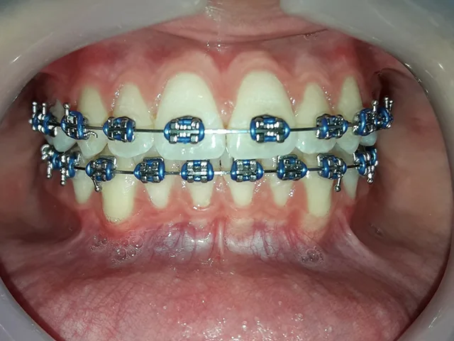 Metall