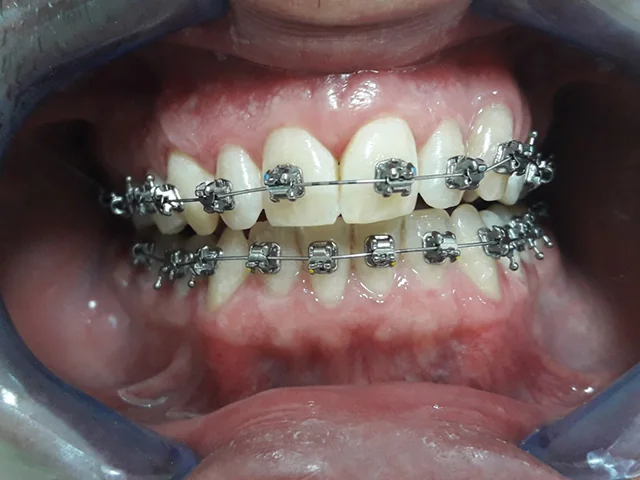 Metall