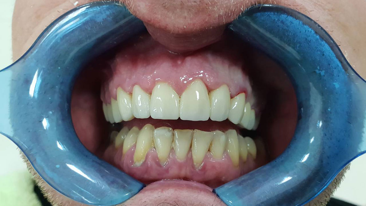 implantologija - slika zuba poslije implantologije