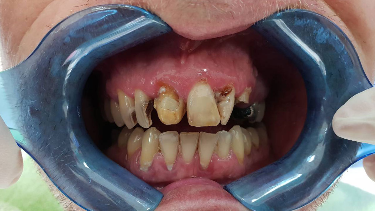 implantologija - slika zuba prije implantologije