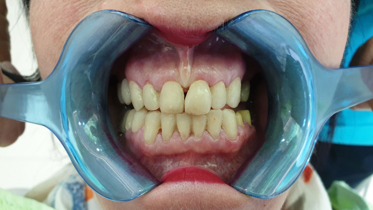 poređenje - prettau - slika zuba prije